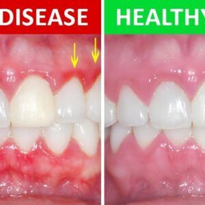 Gum Disease Gone Reviews